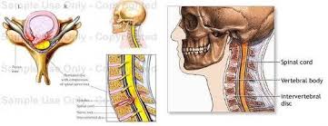 Hernia de disc apare prin prolabarea nucleului pulpos prin fisurile inelului fibros ale discului degenerat spre ligamentul longitudinal posterior astfel: Hernia De Disc Cervicala