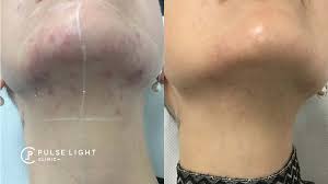 The most common areas we treat at young ldn for pcos sufferers are the face (including chin, cheeks, and upper lip), underarms, stomach, and legs. Pcos Laser Hair Removal Pulse Light Clinic London