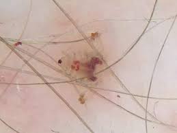 Image result for pubic lice symptoms