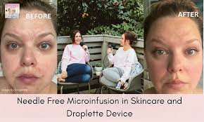 Needle Free Microinfusion in Skincare and Droplette Device