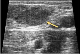 Image result for corpus luteum sonography)