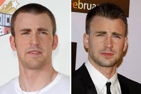 Chris Evans' Hair Transplant