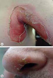Figure 1 From Staphylococcal Scalded Skin Syndrome In An Adult On Chemotherapy Semantic Scholar