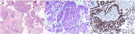 Omental Biopsy Showing Metastatic Deposits Of Invasive Low Grade Serous Download Scientific Diagram