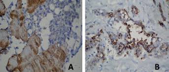 Combined Serum And Immunohistochemical Differentiation Between Reactive And Malignant Mesothelial Proliferations Sciencedirect