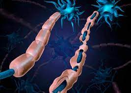 Maybe you would like to learn more about one of these? Esclerosis Multiple Especialista Advierte Que Cada Vez Es Mas Frecuente En Mujeres Portal Red Salud