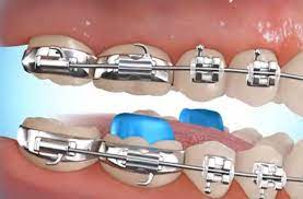 What i didn't expect was the bite turbos. Caring For Braces Mol Orthodontics