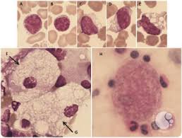 Niemann Pick Disease