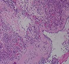 Disseminated aspergillosis originating from pulmonary or intestinal aspergillosis is a rare disease. Word Search Aspergillus Aspergillosis Website