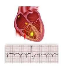 Image result for Extrasystole