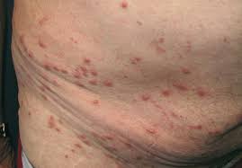 Image result for scabies symptoms