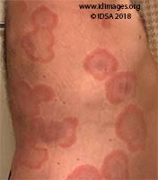 Image result for Erysipeloid