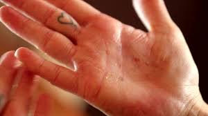 Betrifft neurodermitis hand und handgelenke, gilt es bei der behandlung, äußere auslöser zu vermeiden. Handekzem Was Hilft Gegen Juckende Schmerzende Hande Gesundheit Br Fernsehen Fernsehen Br De
