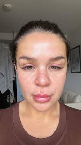 Woke up this morning with my left eye swollen shut there is no puss no  redness its pain full have no clue why its like this took allergy meds but  still can't