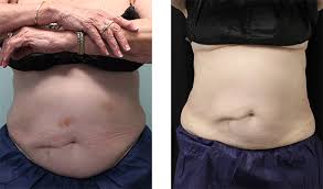 Here's what to know about coolsculpting results—and how long they last. Coolsculpting Before After Greer Plastic Surgery