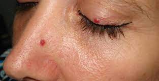 Cherry angiomas are found mainly on the trunk and proximal extremities (figure 1); Cherry Angioma Warrenton Dermatology Skin Therapy Center Board Certified Dermatologists