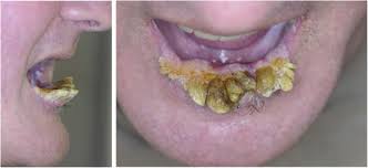 Image result for cornu cutaneum)