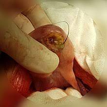 Maybe you would like to learn more about one of these? Teratoma Wikipedia