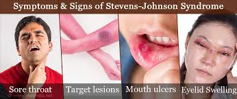 Mucous membranes can also be involved. Stevens Johnson Syndrome Causes Symptoms Diagnosis Treatment Prevention Prognosis