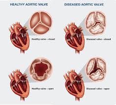 Valvular Heart Valve Disease Baltimore Md Groundbreaking Patient Centered Care That Exemplifies Excellence And Compassion