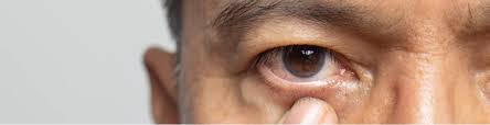 Image result for Acute Red Eye
