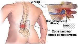 Hernia de disc poate sa apara la orice nivel al coloanei. Cum Scapam De Operatie In Cazul Herniei De Disc Lombare Fizioterapie Bucuresti Kinetoterapie Bucuresti Impachetari Cu Namol Bucuresti