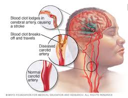 Pembekuan darah merupakan hal biasa yang terjadi jika seseorang mengalami luka atau goresan hingga melukai kulit. Etiologi Strok My Stroke Hospital