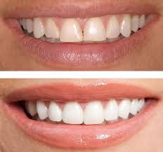 You can find dental implants near me and other cosmetic services to give yourself the healthiest, happiest smile. Cosmetic Dentistry Helps You Achieve A Beautiful Healthy Smile Framingham Premier Dental Blog