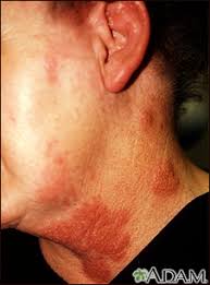 A painful rash around the face, eyes, or ears. Shingles Symptoms And Causes