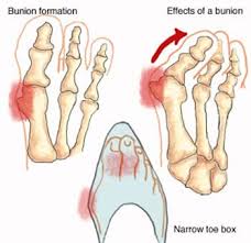 Minimally invasive surgery for bunions was popular in the 80's and 90's. Bunions Corns Specialist 2020 Top Foot Doctor Podiatrist In Nyc