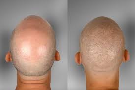 Al fine di simulare la presenza di capelli nelle persone affette da alopecia o per . Tricopigmentazione Spazio Garrarufa Modena