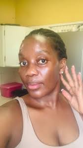 Happy weekend folks ! Day 7 post the accident #youroriginalcivilserviceBae  #SAMA28 #roadto40 #Godgirl #roadaccidentsurvivor