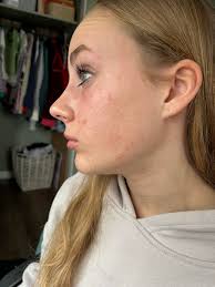 Please help! My daughter is 14 and her skin is having a terrible reaction.  This is not her normal skin.