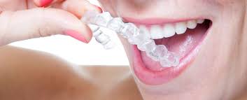 Die aligner schienen sind nahezu unsichtbar, da sie aus hauchdünnem transparentem kunststoff gefertigt werden. Aligner Therapie Kieferorthopadische Ordination Zahnzauber In Wien