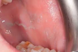 Wund Im Mund Es Ist Zum Gluck Nicht Immer Krebs Zwp Online Das Nachrichtenportal Fur Die Dentalbranche