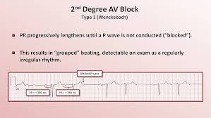 Image result for Atrioventricular Block