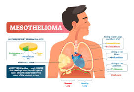 Malignant peritoneal mesothelioma is locally invasive and rarely metastatic past the peritoneum. What Test Shows Mesothelioma Pintas Mullins Law Firm