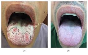 (1)department of oral medicine, guy's and st thomas' nhs foundation trust, london, uk. Secondary Syphilis Presenting As Glossodynia I Plaques En Prairie Fauchee I And A Split Papule At The Oral Commissure Case Report And Review Abstract Europe Pmc