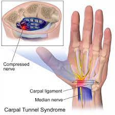 Carpal Tunnel Syndrome - Physiopedia