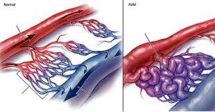 • jangkitan kuman di otak (meningitis). Avm Ibarat Bom Jangka Dalam Otak