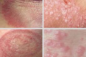 Image result for sore skin in the groin area