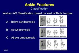 The lateral malleolus is the name provided to the bone on the outside of the ankle joint. Internal Fixation Of Ankle Fractures Ppt Video Online Download