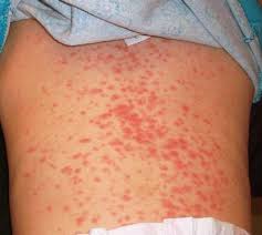 Overview of we also included data on our patients with infectious mononucleosis who were treated between. Mononucleosis Infectiosa
