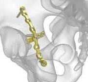 Pelvic Plating System Orthopaedic Solutions Fixation ...