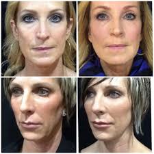 Monistat® works at the site of the infection, curing yeast infections just as effectively as fluconazole while relieving symptoms much sooner.1** so how long does it take for. Sculptra Duluth Smile Line Fillers Northern Minnesota Twin Ports Dermatology Duluth Mn