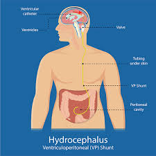 Kamran Aghayev Neurosurgeon Hydrocephalus