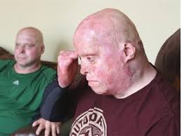 Brothers badly burned in Fort Saskatchewan house explosion to receive  courage award