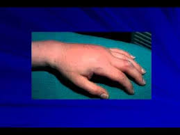 Pin On Crps Rsd Chronic Pain