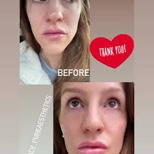 A little cheek and under eye filler...