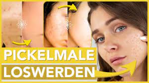 Vorher nachher ergebnisse unserer patienten auf einem blick ▶ jetzt weiterlesen für mehr infos! Pickelmale Einfach Sicher Und Schmerzfrei Zuhause Selbst Entfernen